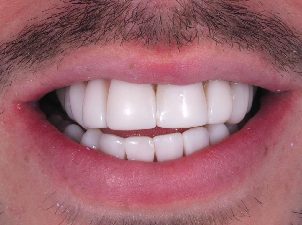 Male teeth after composite bonding.