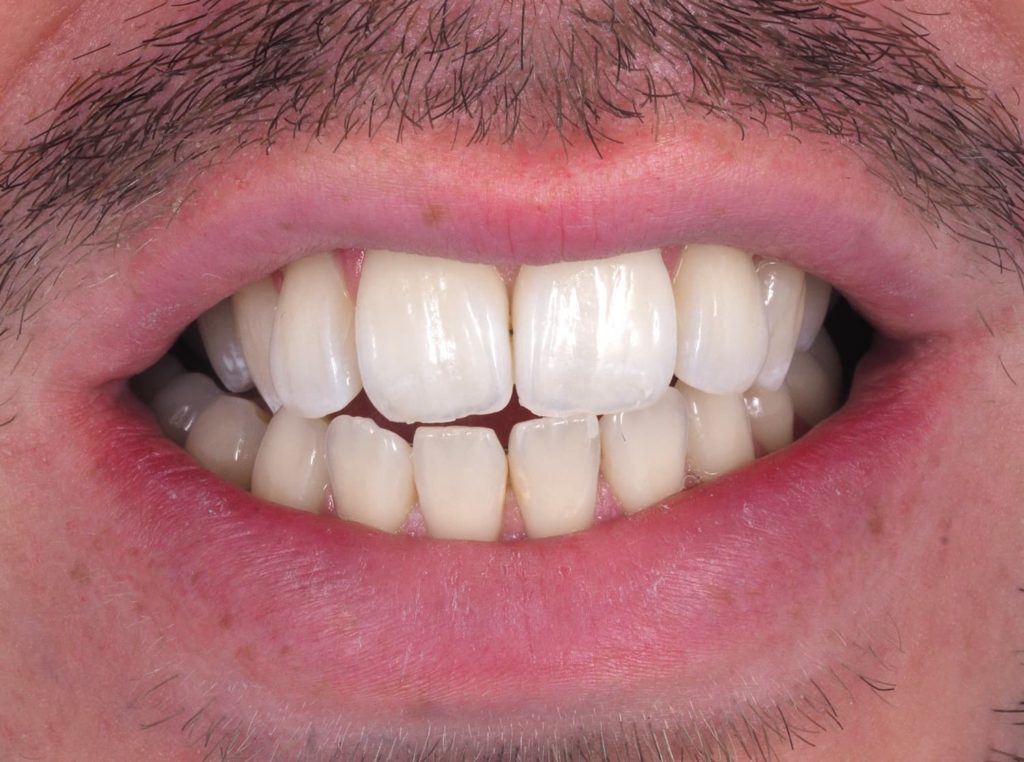 Male teeth before composite bonding.